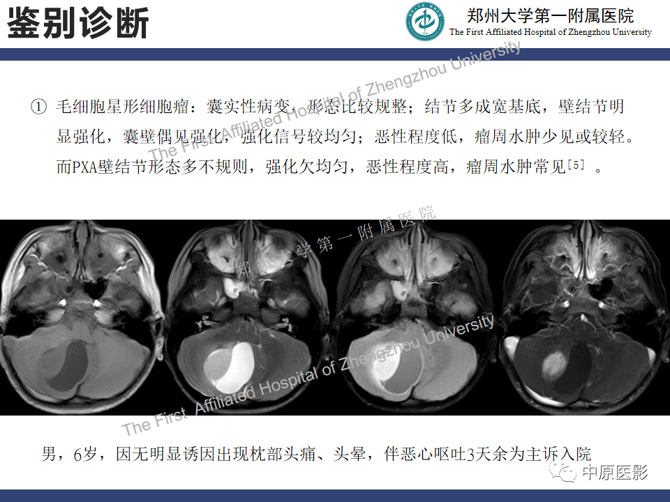 影像PPT - 【病例】小脑多形性黄色瘤性星形细胞瘤1例MR影像-15