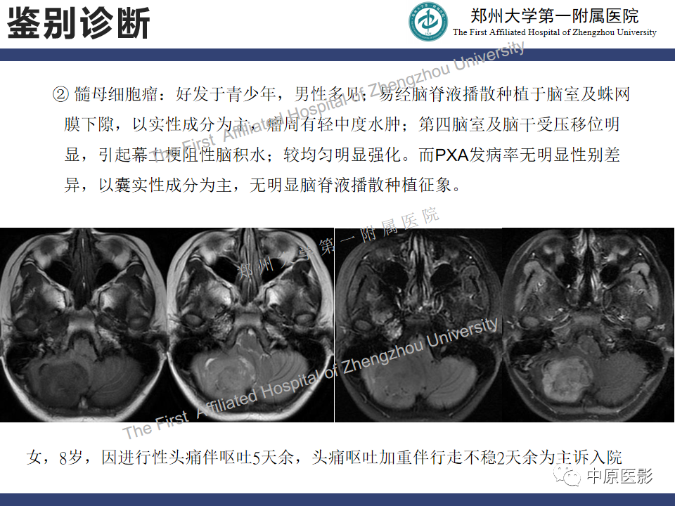 影像PPT - 【病例】小脑多形性黄色瘤性星形细胞瘤1例MR影像-16