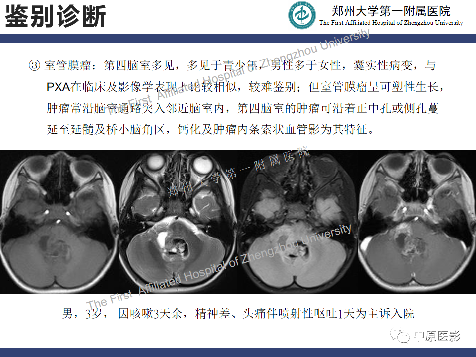 影像PPT - 【病例】小脑多形性黄色瘤性星形细胞瘤1例MR影像-17