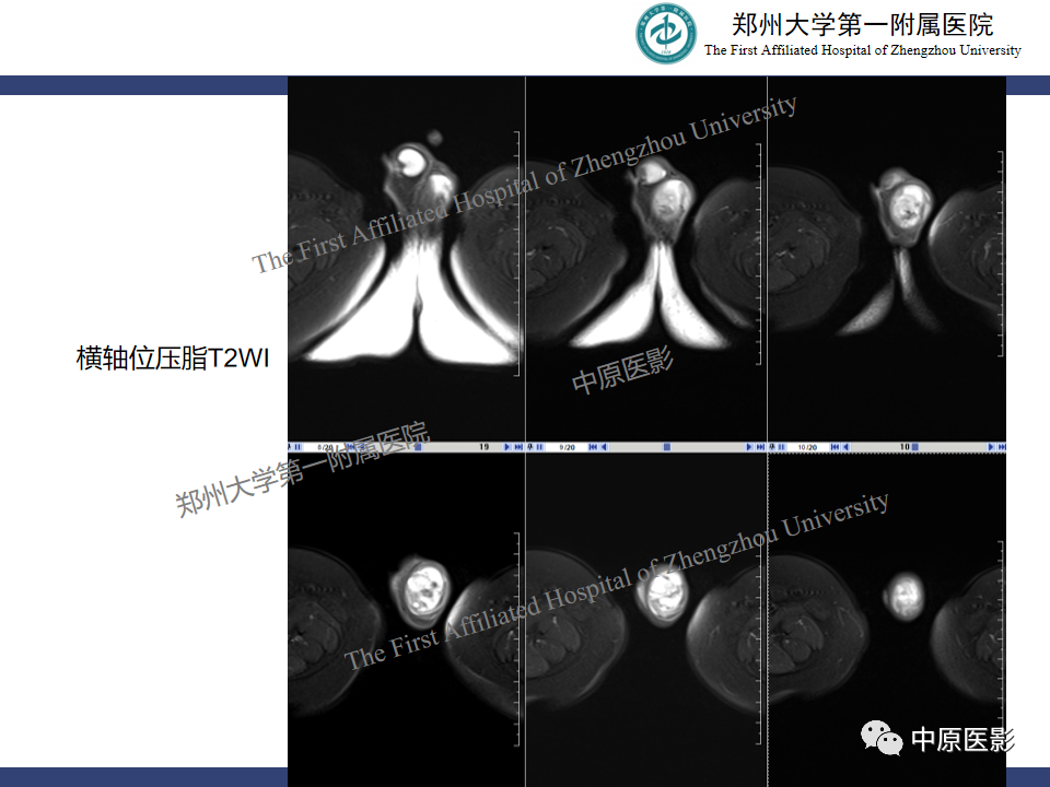 影像PPT - 【病例】睾丸畸胎瘤1例MR影像-4