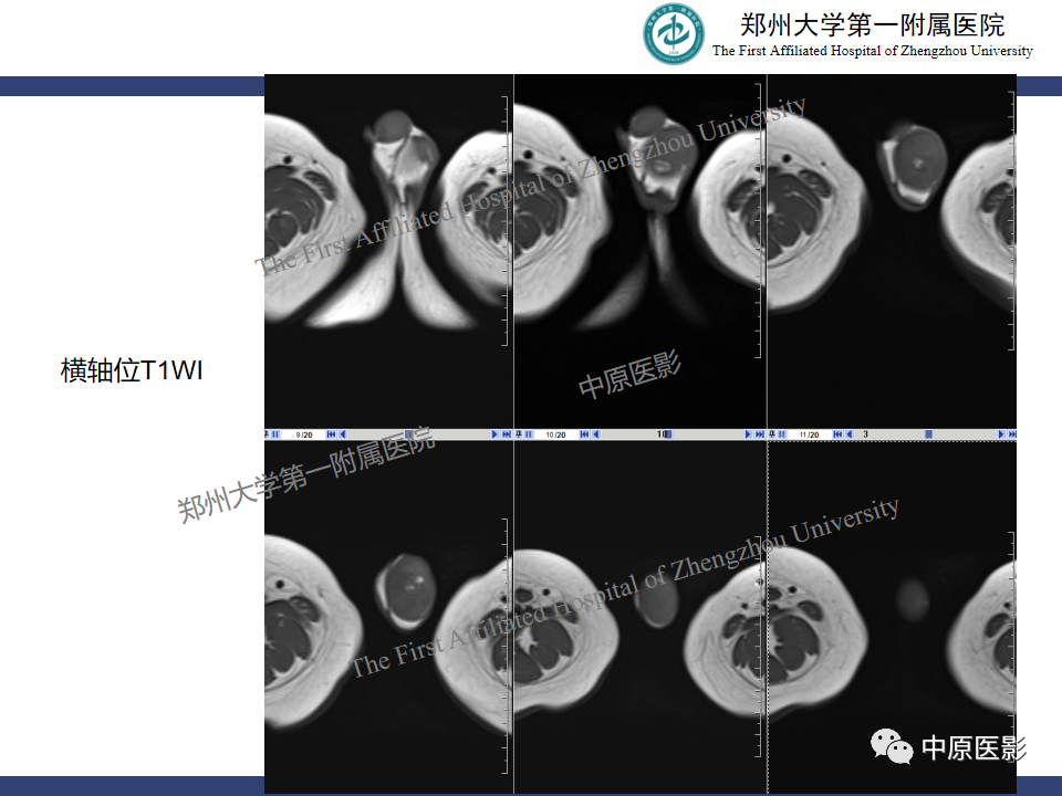 影像PPT - 【病例】睾丸畸胎瘤1例MR影像-3