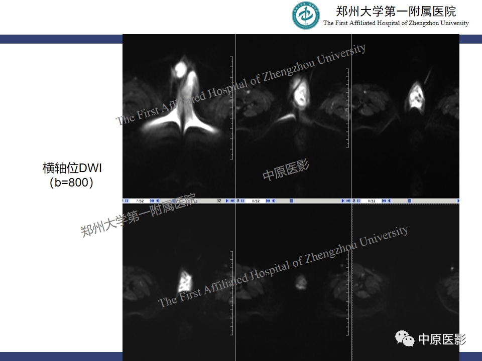 影像PPT - 【病例】睾丸畸胎瘤1例MR影像-5
