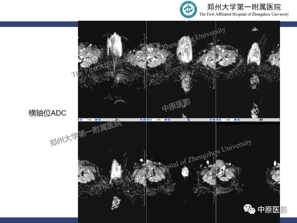 影像PPT - 【病例】睾丸畸胎瘤1例MR影像-6