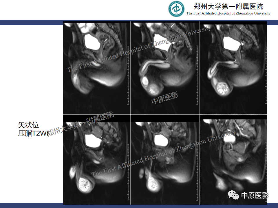 影像PPT - 【病例】睾丸畸胎瘤1例MR影像-7
