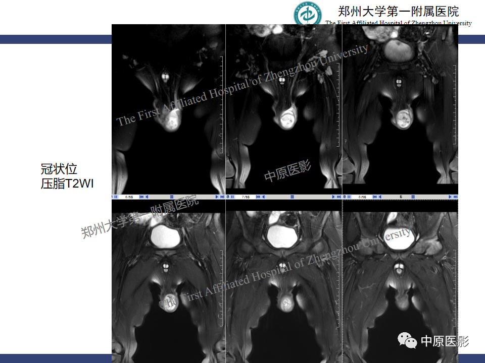 影像PPT - 【病例】睾丸畸胎瘤1例MR影像-8