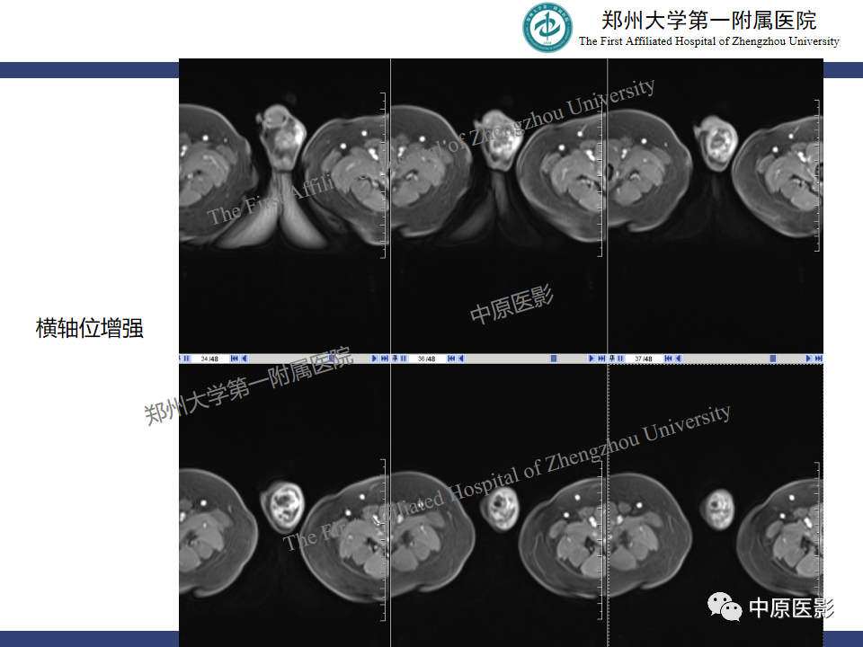影像PPT - 【病例】睾丸畸胎瘤1例MR影像-9