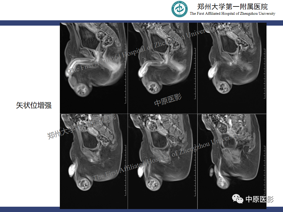 影像PPT - 【病例】睾丸畸胎瘤1例MR影像-10