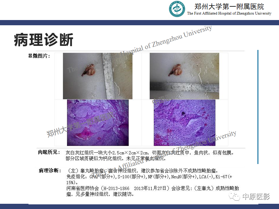 影像PPT - 【病例】睾丸畸胎瘤1例MR影像-14