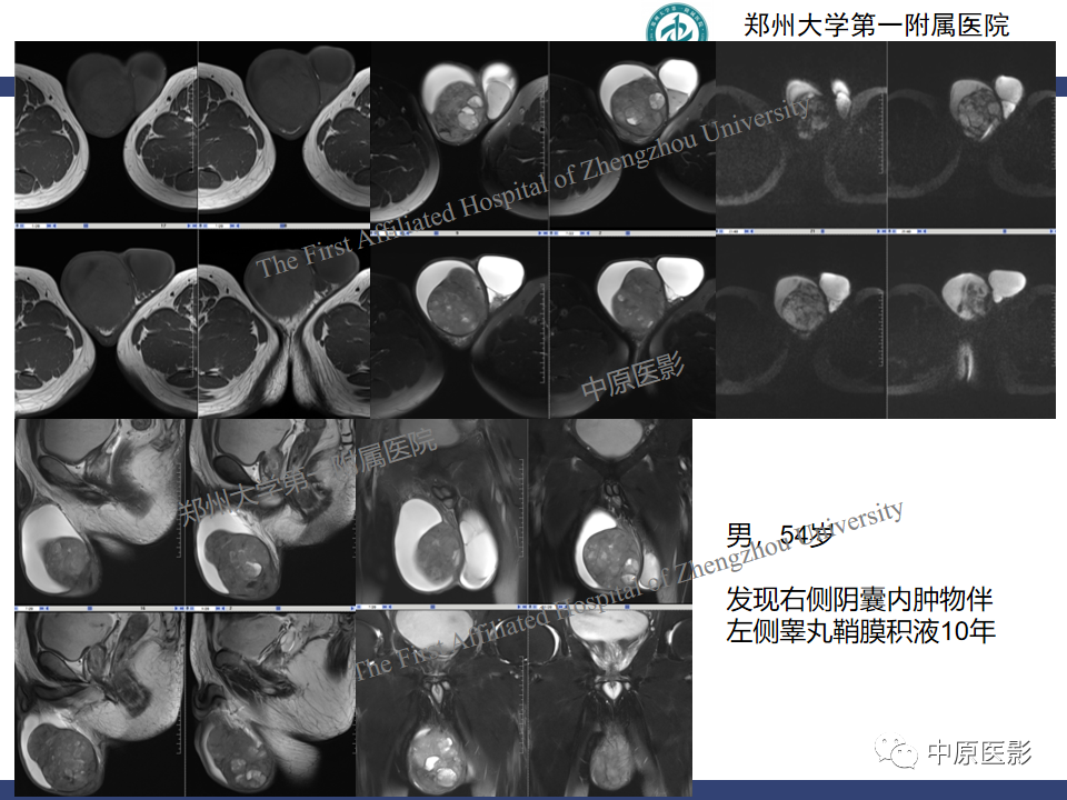 影像PPT - 【病例】睾丸畸胎瘤1例MR影像-24