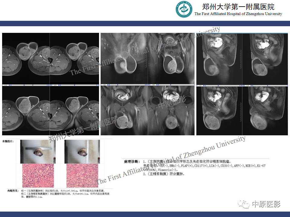 影像PPT - 【病例】睾丸畸胎瘤1例MR影像-25
