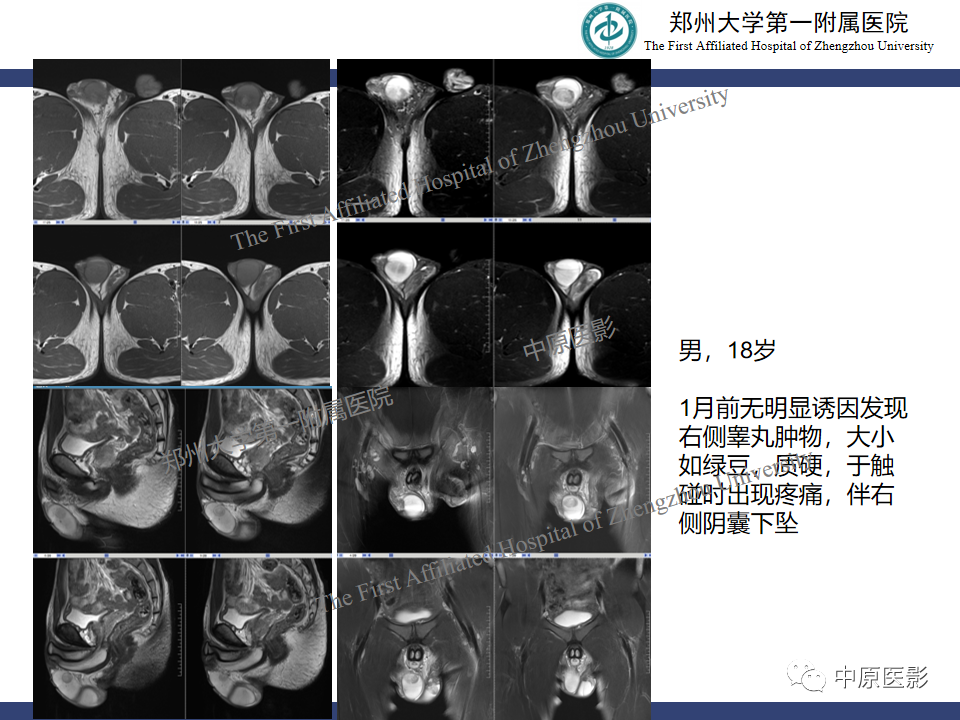 影像PPT - 【病例】睾丸畸胎瘤1例MR影像-28