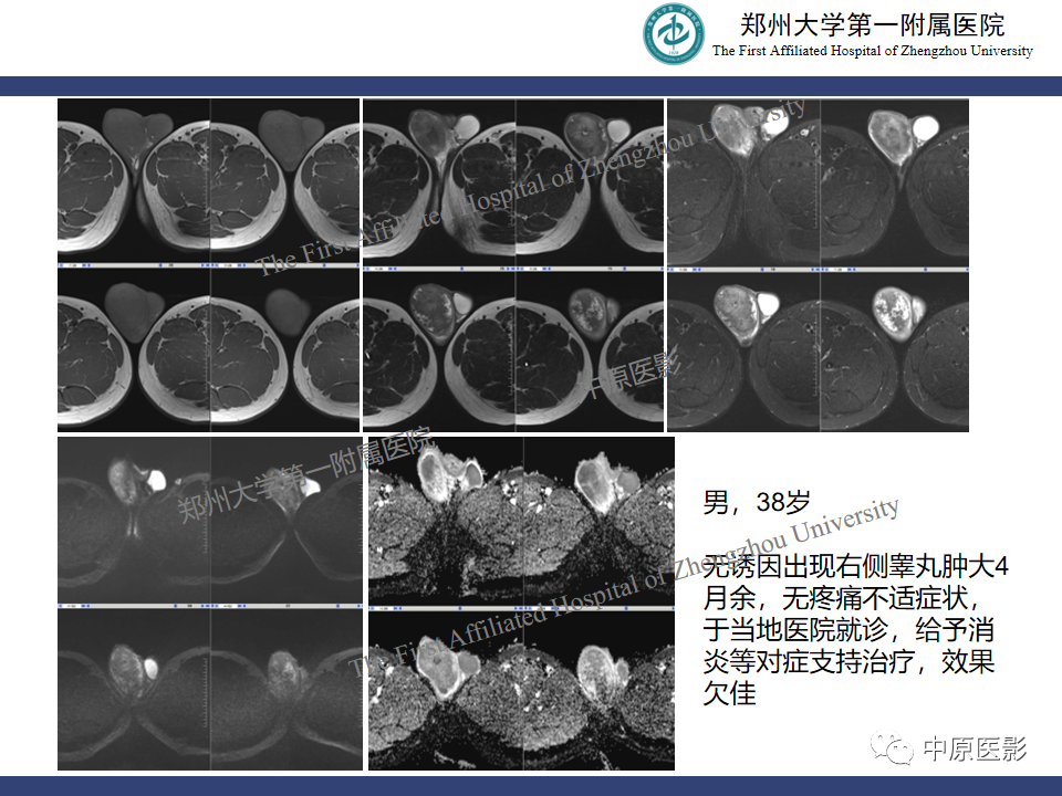 影像PPT - 【病例】睾丸畸胎瘤1例MR影像-31