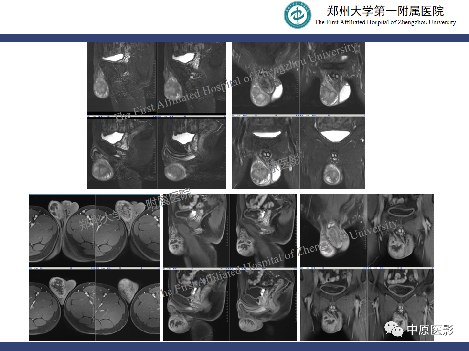 影像PPT - 【病例】睾丸畸胎瘤1例MR影像-32