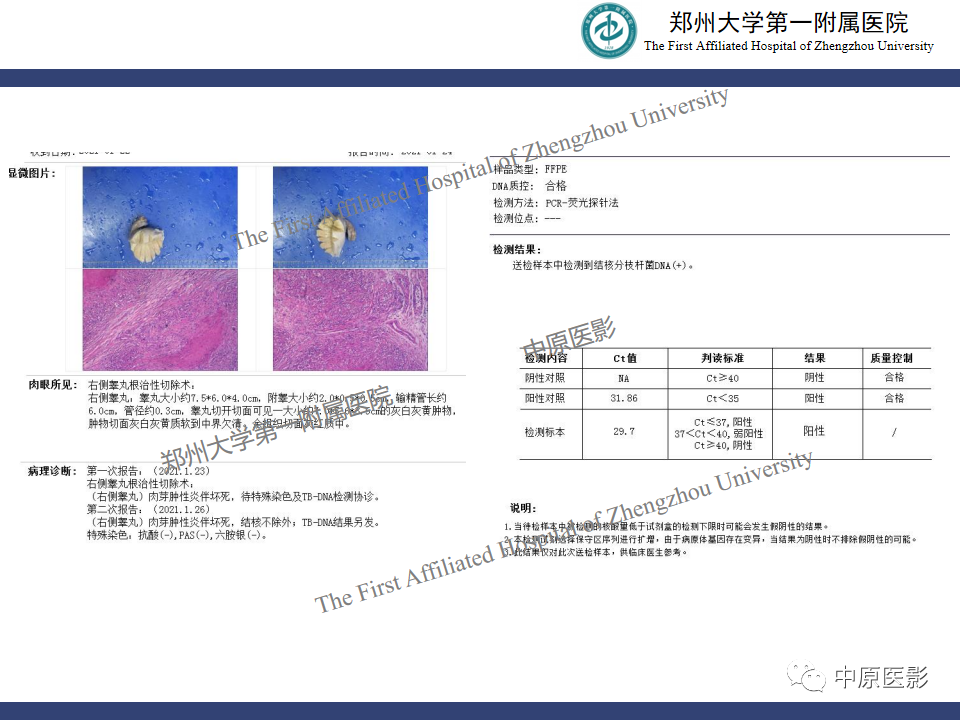 影像PPT - 【病例】睾丸畸胎瘤1例MR影像-33