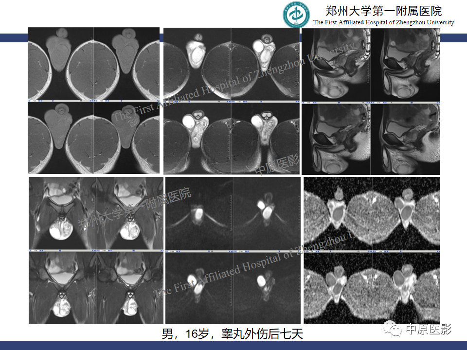 影像PPT - 【病例】睾丸畸胎瘤1例MR影像-35
