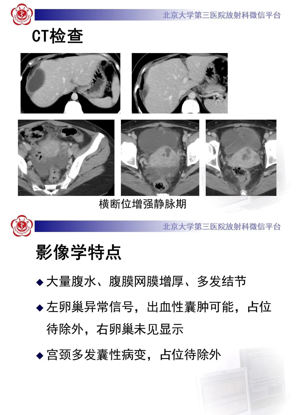 影像PPT - 【PPT】宫颈胃型腺癌-5
