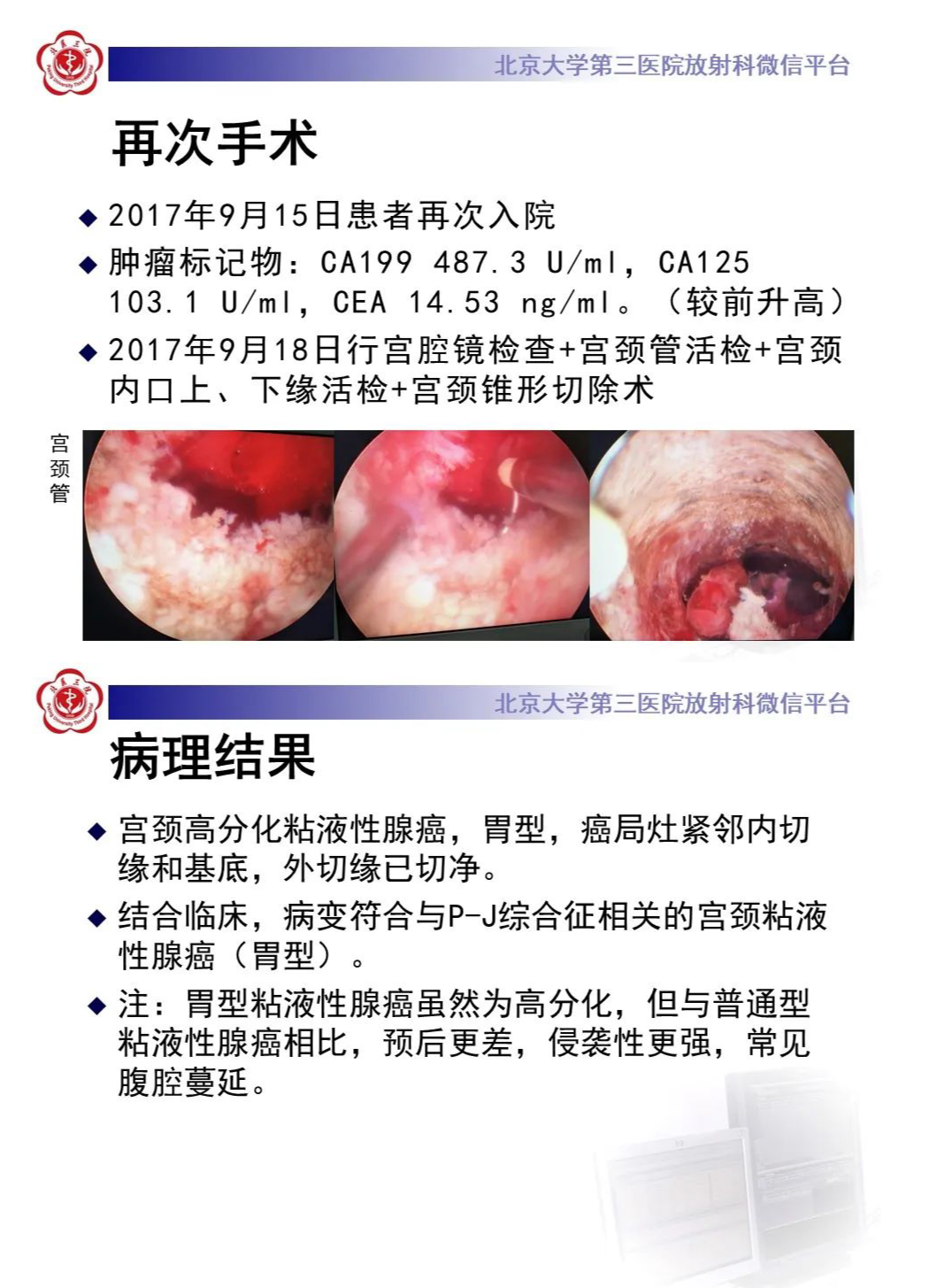 影像PPT - 【PPT】宫颈胃型腺癌-8
