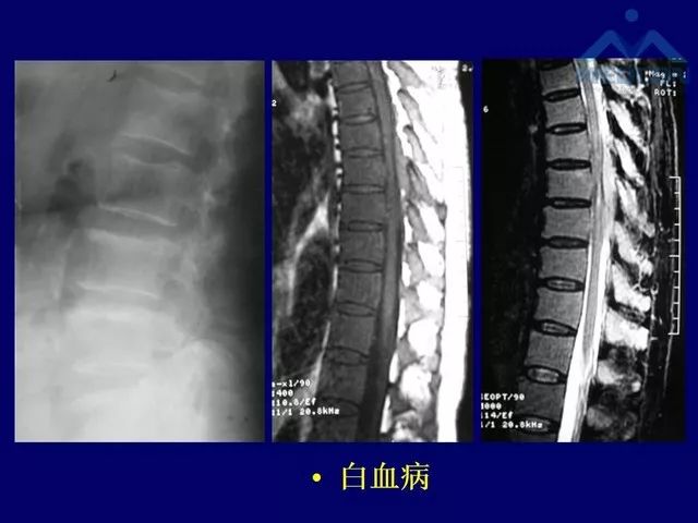 影像PPT - 【PPT】脊柱肿瘤影像诊断思路-4