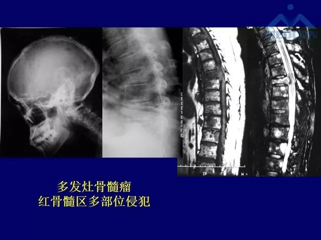 影像PPT - 【PPT】脊柱肿瘤影像诊断思路-5
