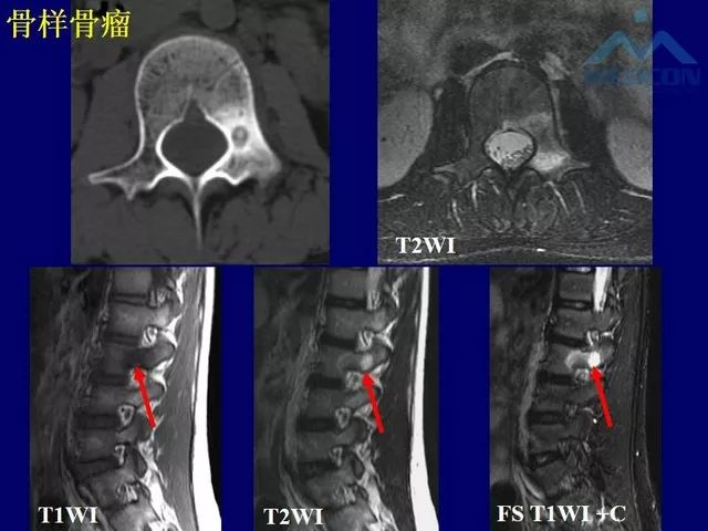 影像PPT - 【PPT】脊柱肿瘤影像诊断思路-15