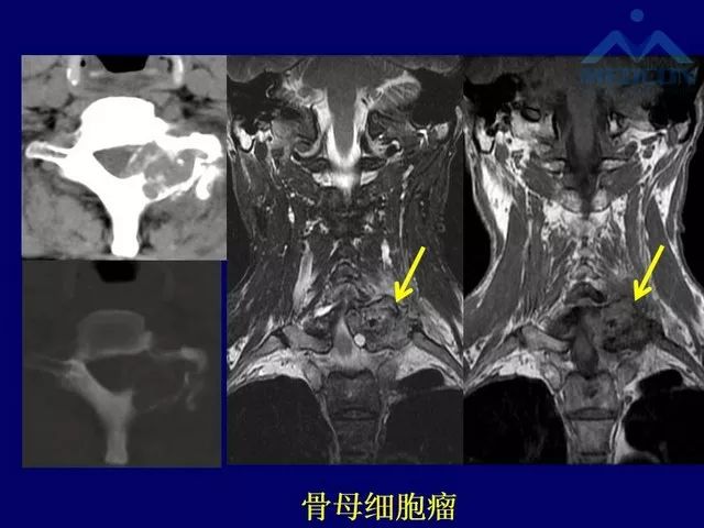 影像PPT - 【PPT】脊柱肿瘤影像诊断思路-17