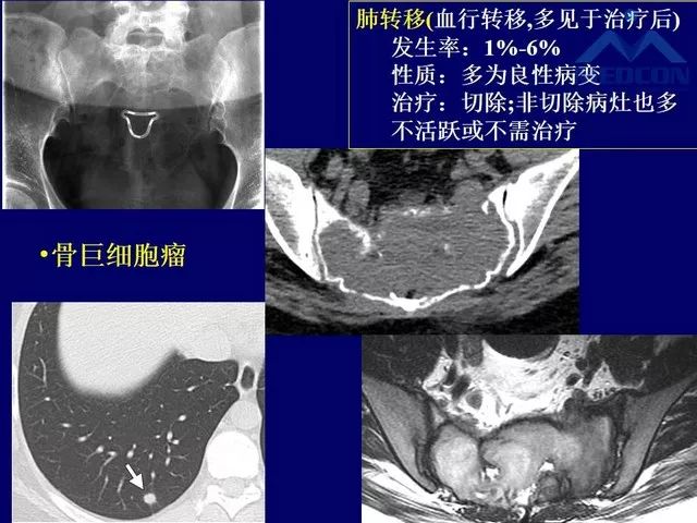 影像PPT - 【PPT】脊柱肿瘤影像诊断思路-20