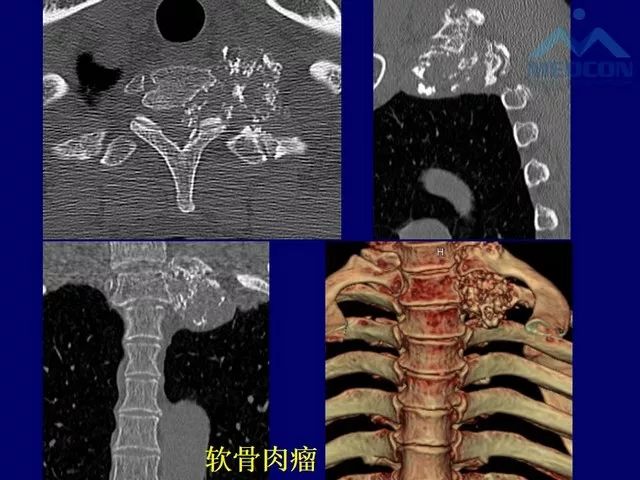 影像PPT - 【PPT】脊柱肿瘤影像诊断思路-24