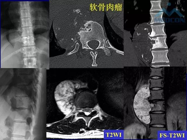 影像PPT - 【PPT】脊柱肿瘤影像诊断思路-25