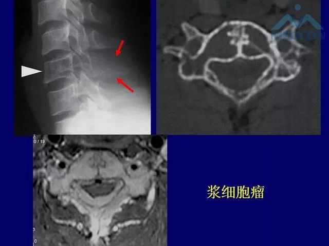 影像PPT - 【PPT】脊柱肿瘤影像诊断思路-27