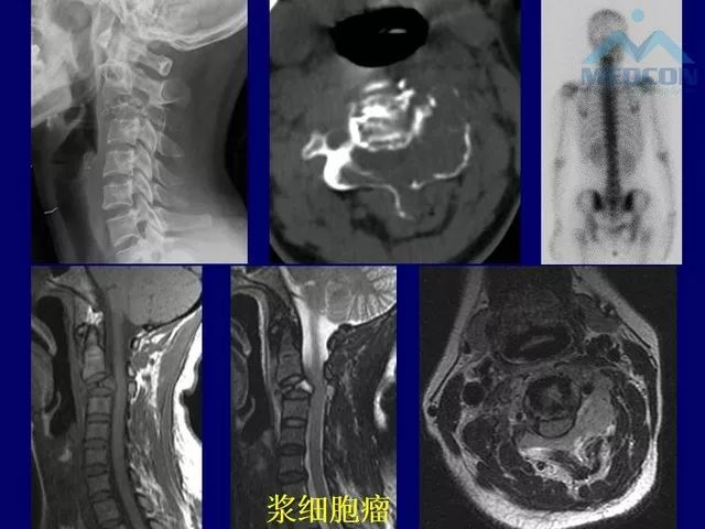 影像PPT - 【PPT】脊柱肿瘤影像诊断思路-28