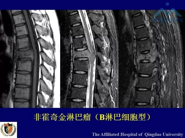 影像PPT - 【PPT】脊柱肿瘤影像诊断思路-30