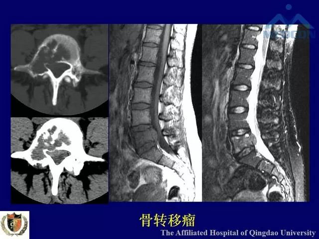 影像PPT - 【PPT】脊柱肿瘤影像诊断思路-35