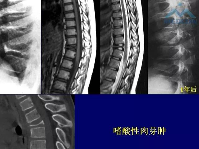影像PPT - 【PPT】脊柱肿瘤影像诊断思路-40