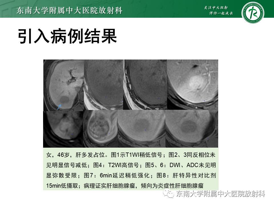 影像PPT - 【PPT】肝细胞腺瘤-5