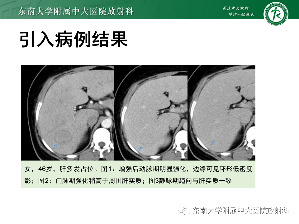 影像PPT - 【PPT】肝细胞腺瘤-4