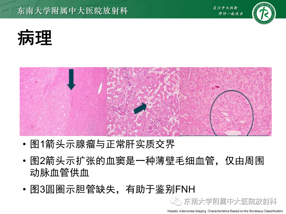 影像PPT - 【PPT】肝细胞腺瘤-11