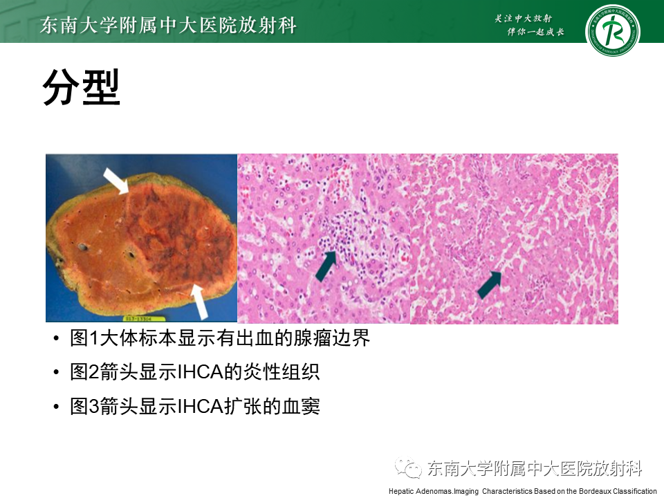 影像PPT - 【PPT】肝细胞腺瘤-13