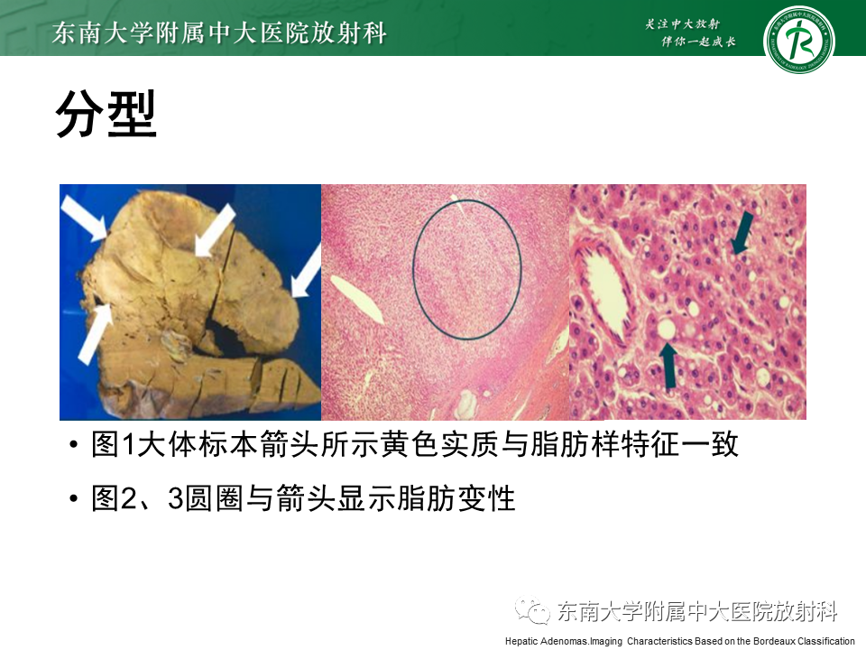 影像PPT - 【PPT】肝细胞腺瘤-15
