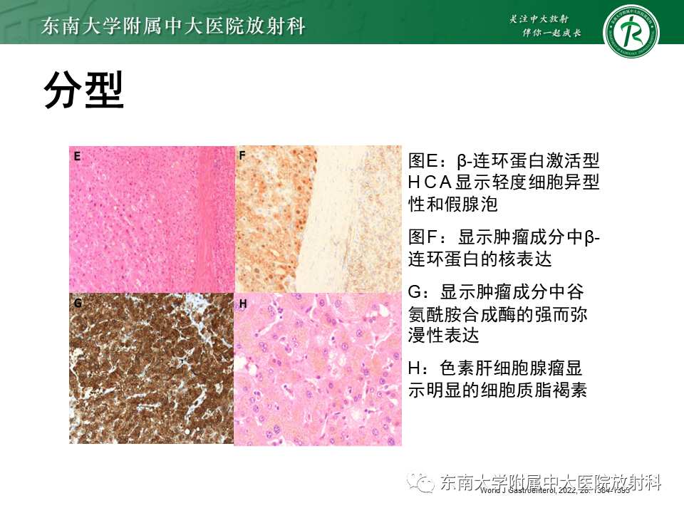 影像PPT - 【PPT】肝细胞腺瘤-17