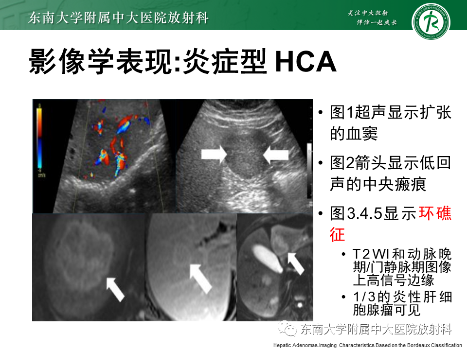影像PPT - 【PPT】肝细胞腺瘤-21