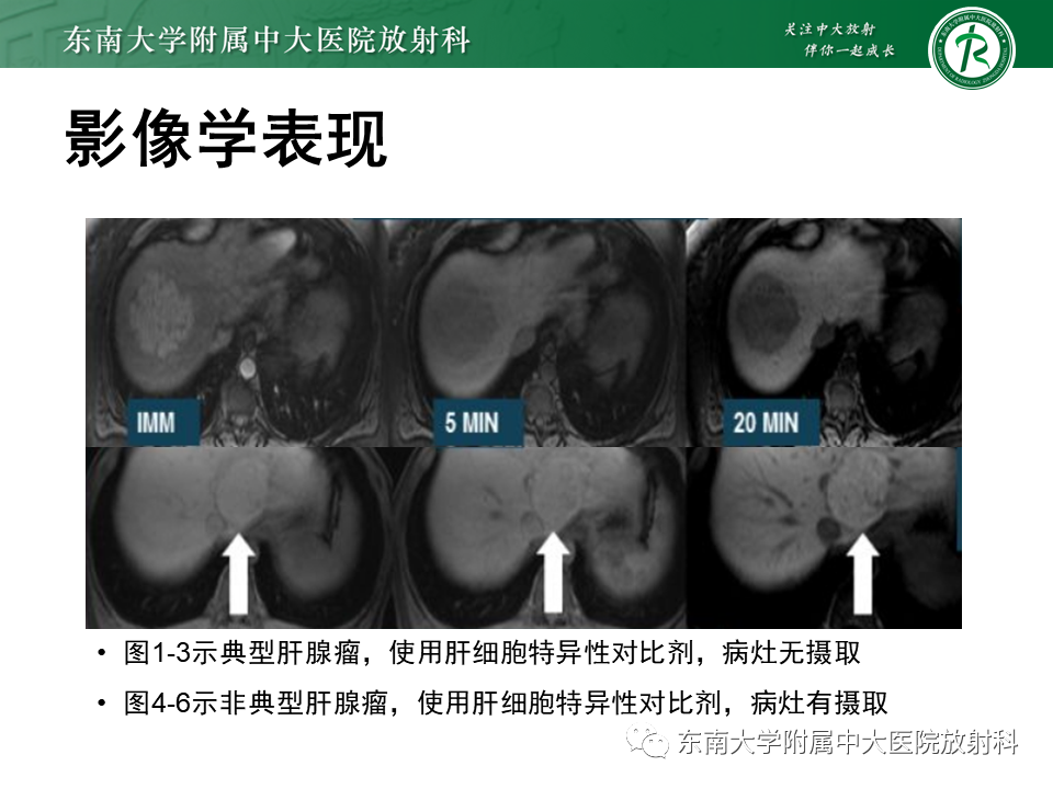 影像PPT - 【PPT】肝细胞腺瘤-25