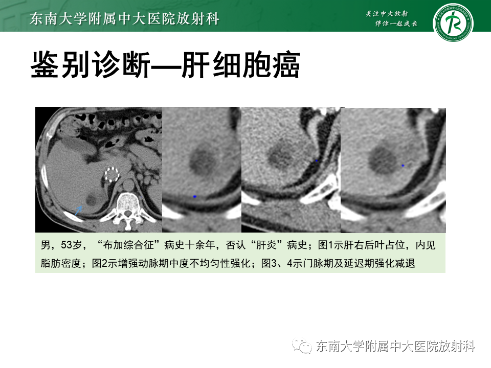影像PPT - 【PPT】肝细胞腺瘤-31