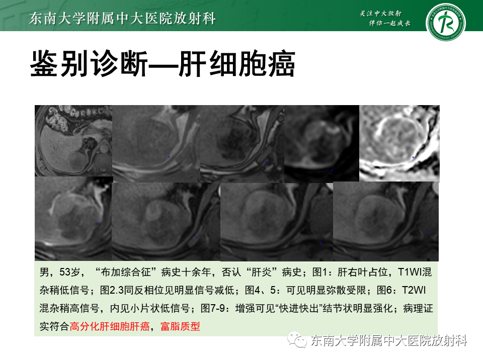 影像PPT - 【PPT】肝细胞腺瘤-32