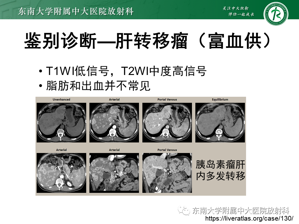 影像PPT - 【PPT】肝细胞腺瘤-38