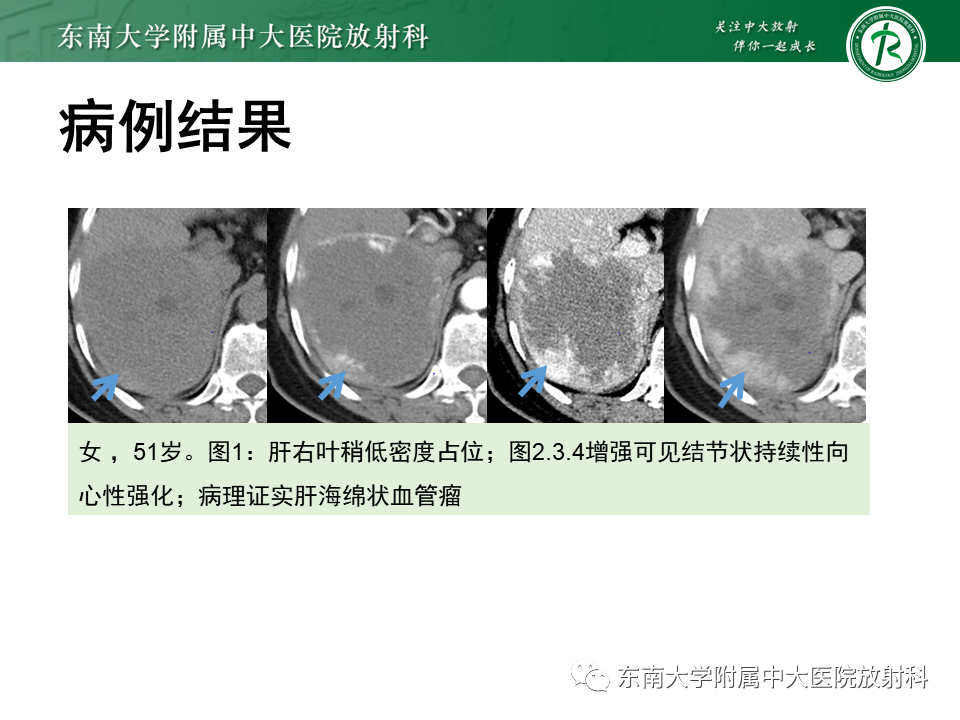 影像PPT - 【PPT】肝细胞腺瘤-40