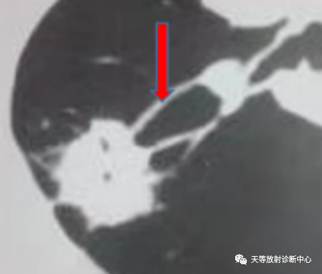 影像PPT - 圆形肺不张-4 影像PPT - 圆形肺不张-4