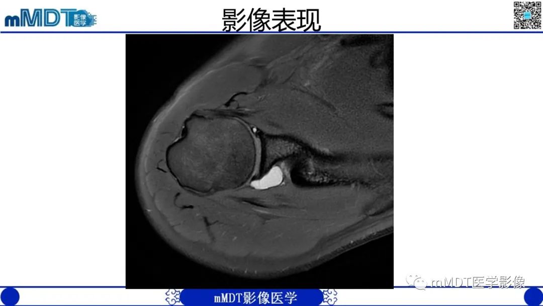 影像PPT - 【PPT】冈盂切迹囊肿继发肩胛上神经卡压-3