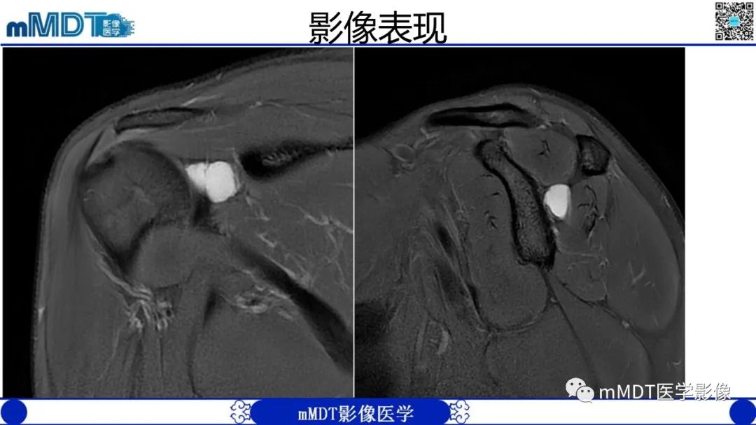 影像PPT - 【PPT】冈盂切迹囊肿继发肩胛上神经卡压-2