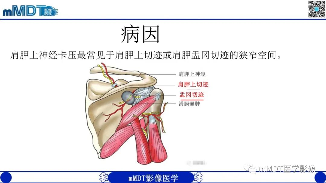 影像PPT - 【PPT】冈盂切迹囊肿继发肩胛上神经卡压-7