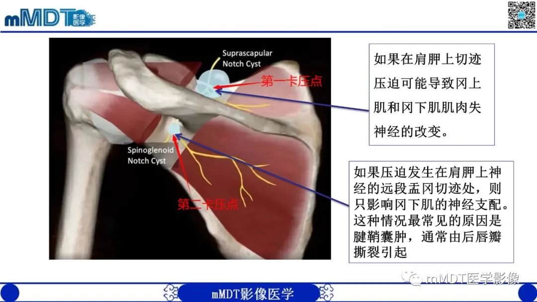 影像PPT - 【PPT】冈盂切迹囊肿继发肩胛上神经卡压-9